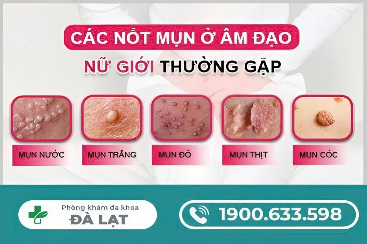 Hình ảnh minh họa